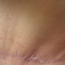 Scar @ 6.5 weeks - this is my bad side