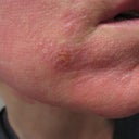 Me right now - day 11 - still red, and You can see the last scabby remains of my chin blisters, plus those hard, raised dots everywhere. (these healed fine!!)