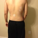 One day after Smart lipo.