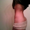6 weeks post op right side
