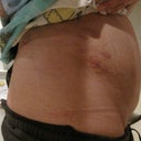 very swollen and 4 lbs heavier than when I started.  I WILL be patient. 2 days out.
