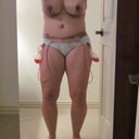 Post-op day 3 SWOLLEN