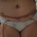 Post-op day 3 lower incision front