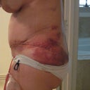 Post-op day 3 lower incision side, bad bruising from the lipo