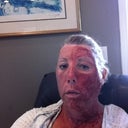 Day 1, after the procedure.  (There is PRP on the left side of my face.)