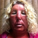 Day 2 in the afternoon.  I had a LOT of swelling that day, to the point where I could not see well enough to drive.