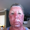 Day 3. The swelling is migrating south, and I am starting to "bronze."