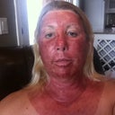 Day 4. Things are starting to look up, but I am nowhere even close to being able to go out in public.