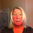 Day 5. Still somewhat swollen. Still very red. A great deal of skin has peeled off.