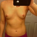 Before. That nonsense I first said about keeping this breast size, if i could just loose my excess weight...ha! What was I thinking, clearly pre-surgery crazy talk!