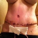 5 days PO...pretty swollen...but happy with my results!!