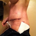 side view...5 days PO. alot of binder marks...and swelling...but otherwise I'm happy. I mean...let's compare to my pre-op! lol