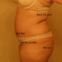 9 days pre-op before side profile