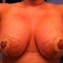 day 3 post op getting used to showering and being naked its uncomfortable but not painful unless u cough laugh or sneeze