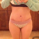 3.5 weeks postop, tape removed