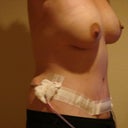 two week post op. 10-26-2010