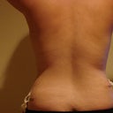 two week post op. 10-26-2010