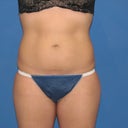 Before- Front