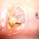 Infection