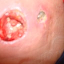 End result from surgical debribement