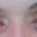 this is the pain I went through getting it removed with laser.