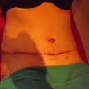 Post Op day 6 - first peek at cut