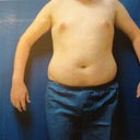 Pre-Surgery