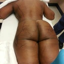 Pic taken right before surgery.  Notice how my left hip is lopsided.  Well Dr. B fixed that.