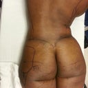Pic taken right before surgery.  Notice how my left hip is lopsided.  Well Dr. B fixed that.