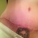 scar 2 months po