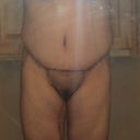 19 days post op