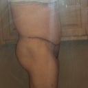 19 days post op side