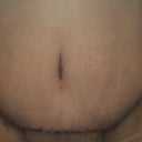 19 days post op belly button close up