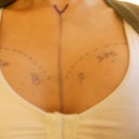 350cc silicone on right breast...375cc silicone on left breast.