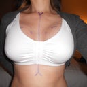 Day1 post op