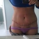 I got off my lazy butt and here is a pic standing up.  Im a little upset with the curve of the left side, but there is the drain there still so that might be the issue.  I'll get a pic of the side when the drain comes out, I have an extended scar...