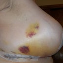 Post op day 7 side