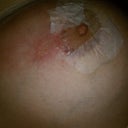 This is where my skin used to be....it is now in the trash with the piece of tape that took it.