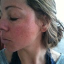 side view, I have sun spots and AK's