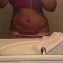 Front view-day after surgery