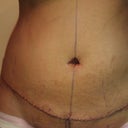 front view-day after surgery