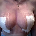 After explant and lift