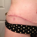 post-op 3 weeks scar