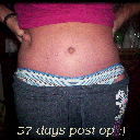 57 days post op :)