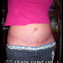 57 days post op :)