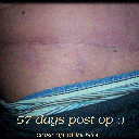 57 days post op :)