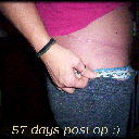 57 days post op :)