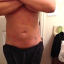 Day after smart lipo. On upper/ lower abs + waist.