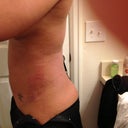 Day after smart lipo