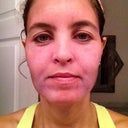 Day 5...getting ready to slough off.. Swelling going down